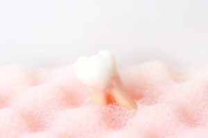 抜歯を避ける神経治療の重要性