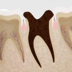 歯の神経治療の時間とその過程